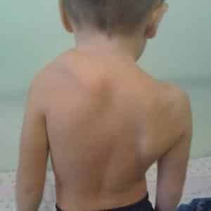 Как лечить болезнь Шпренгеля