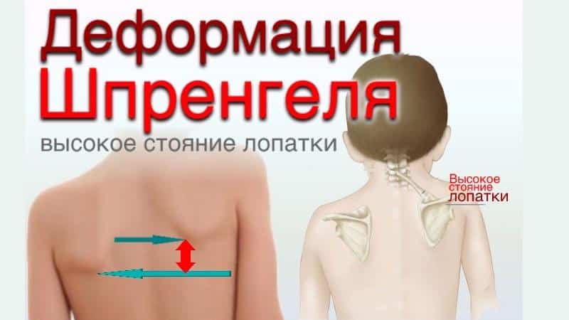 Как лечить болезнь Шпренгеля