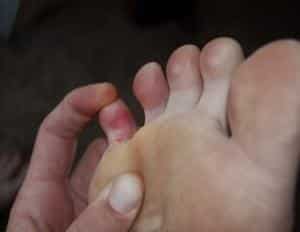 Как лечить перелом мизинца на ноге