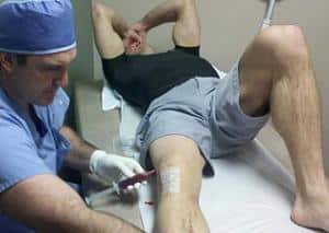 Что такое бурсит коленного сустава и как его лечить