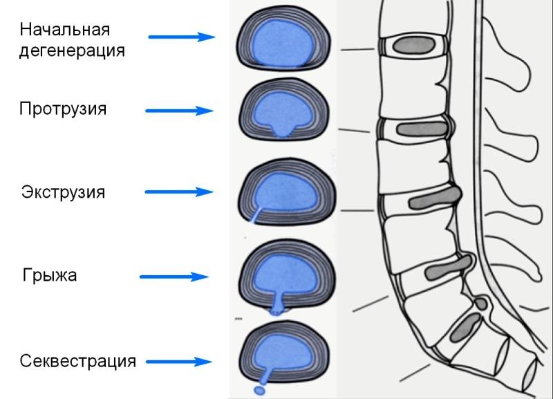 Протрузия межпозвонкового диска