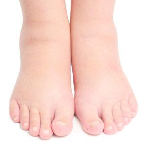 Что делать, если нога опухла