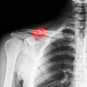 Как лечить перелом ключицы