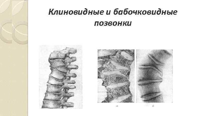 Что такое бабочковидный позвонок