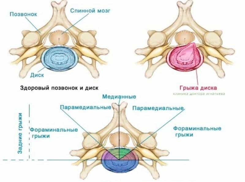 Типы грыжи