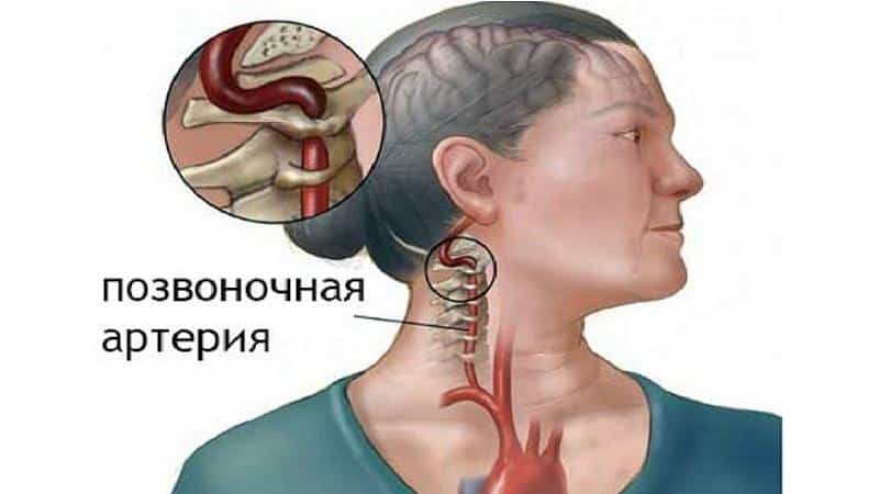 Что такое экстравазальная компрессия позвоночной артерии и как она лечится