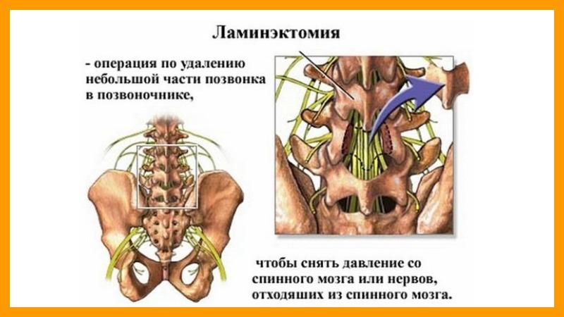 Ламинэктомия