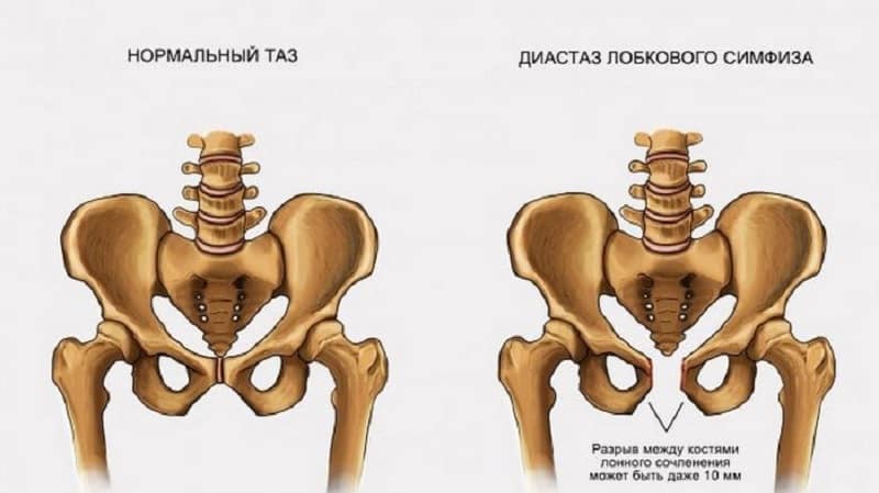 Что такое лонное сочленение