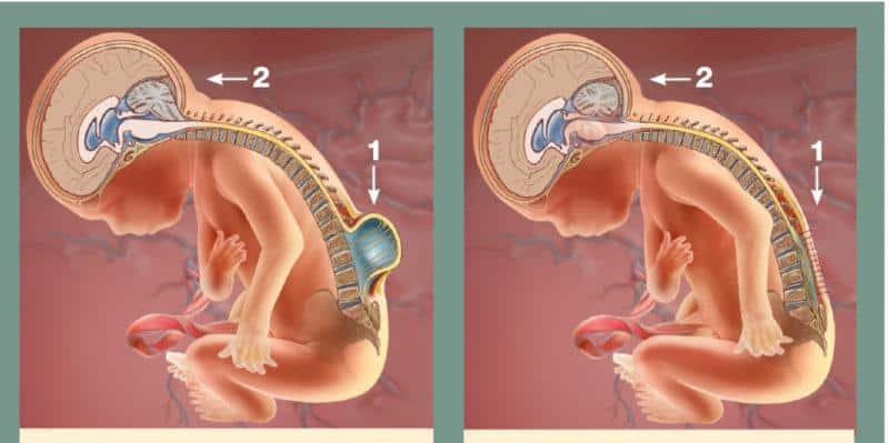 Что такое миелодисплазия и как её лечат