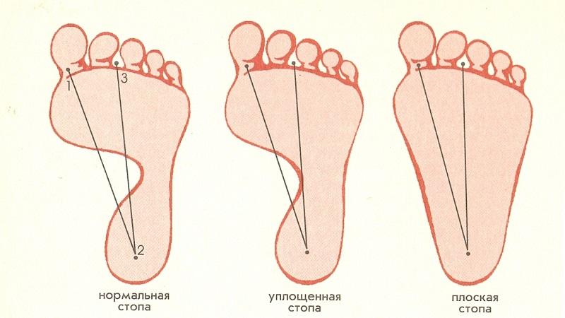Что такое плантограмма стопы и как её делают
