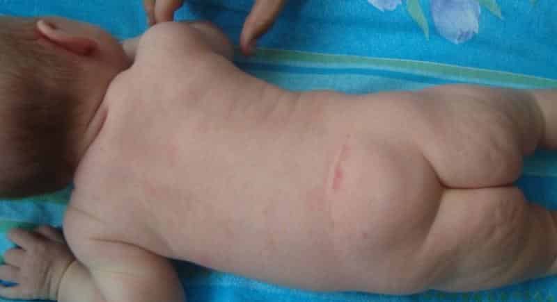 Что такое расщепление позвоночника и как его лечить