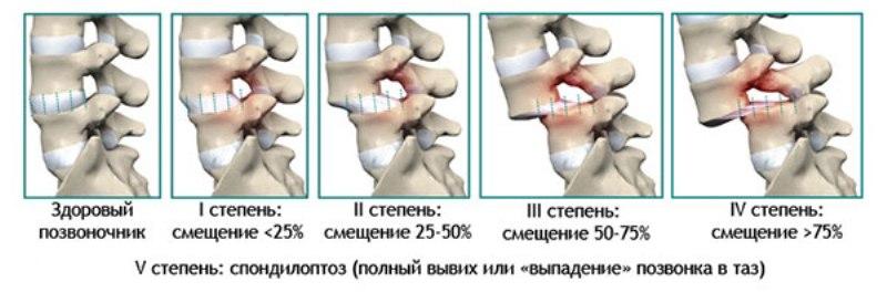 Степени ретролистеза