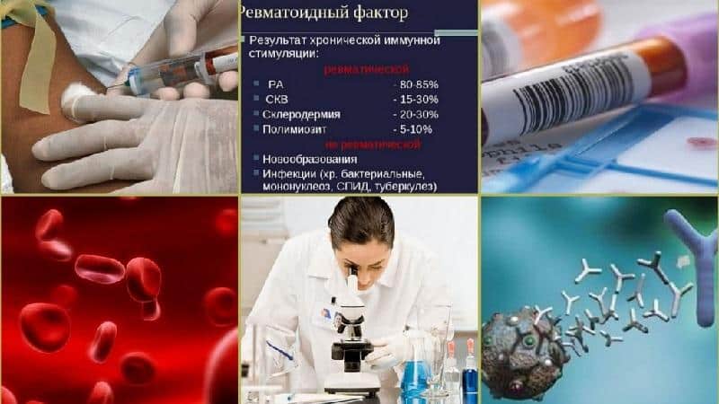Что такое ревматоидный фактор
