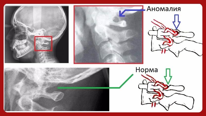 Синдром Киммерле
