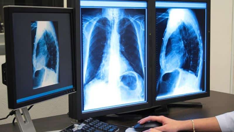 Что такое сцинтиграфия костей