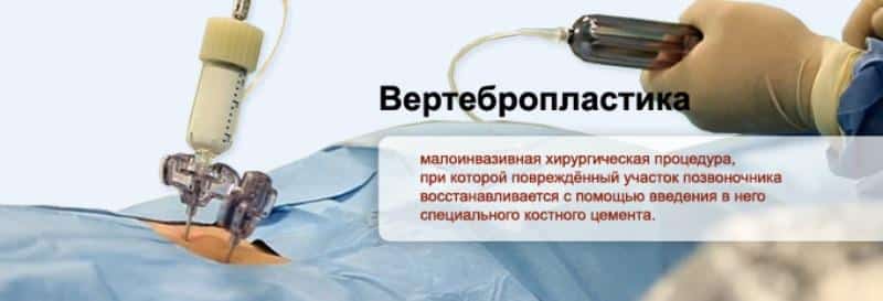 Вертебропластика