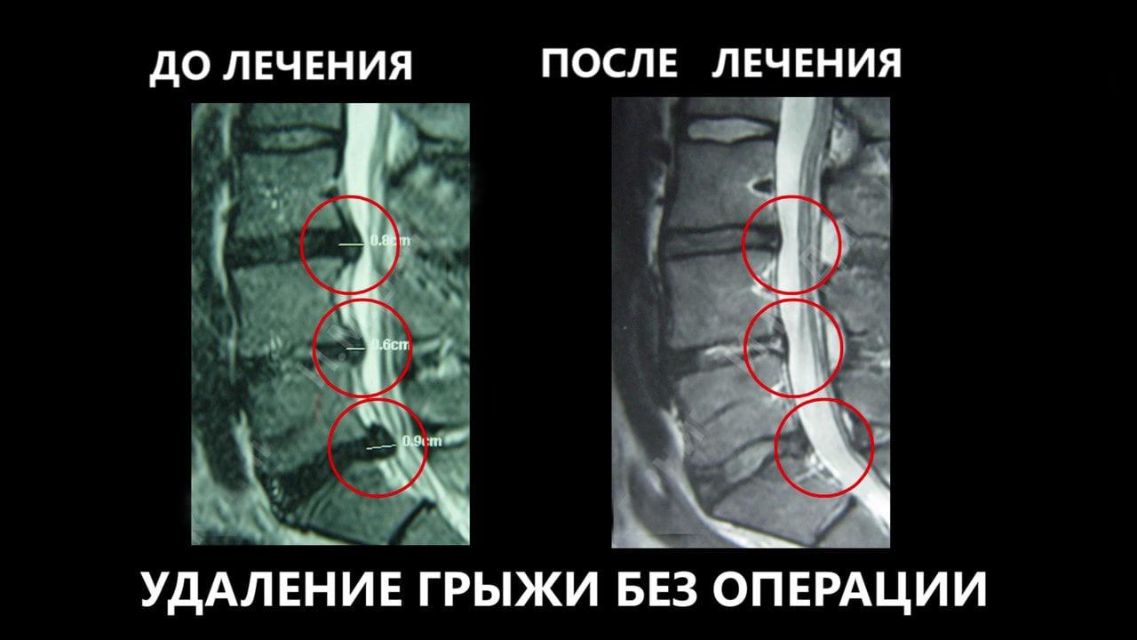 Что такое вертеброревитология