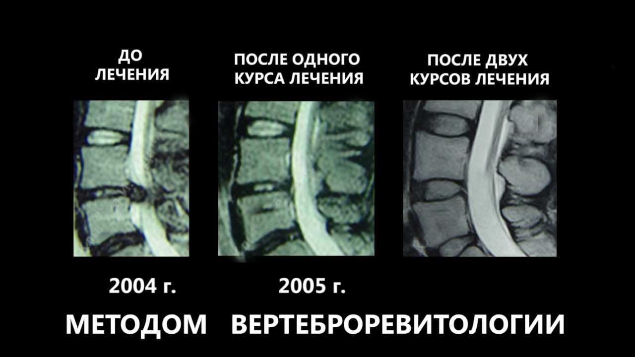 Что такое вертеброревитология