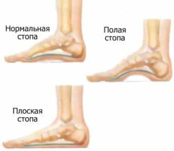 Что такое высокий подъем стопы