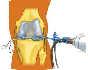 Как лечить кисту Бейкера под коленом