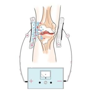 Электрофорез коленного сустава