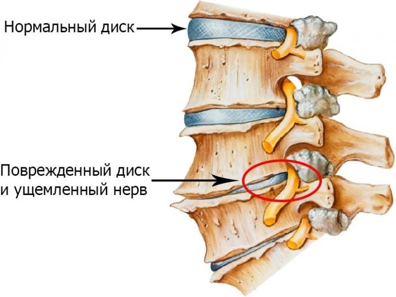 Как лечить фасеточный синдром