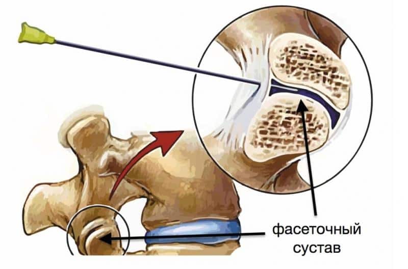 Как лечить фасеточный синдром