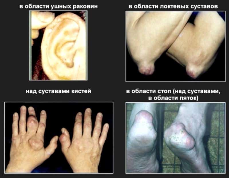 Подагрические образования