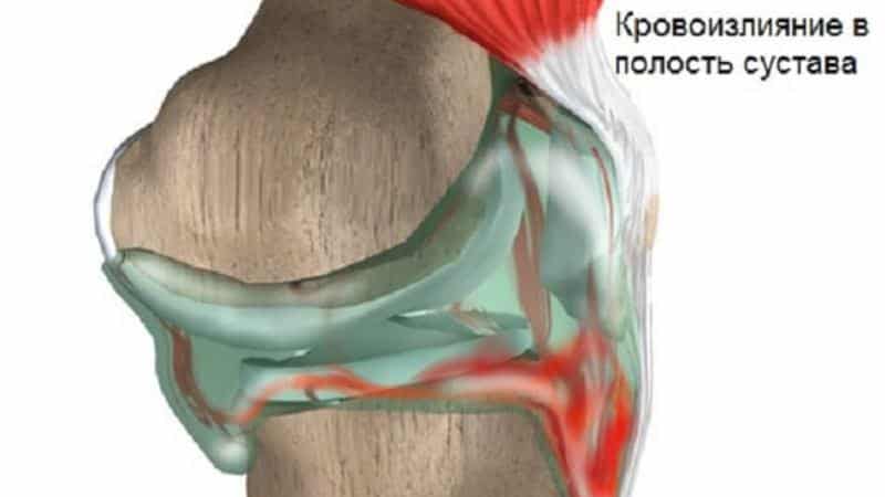 Как лечить гемартроз коленного сустава