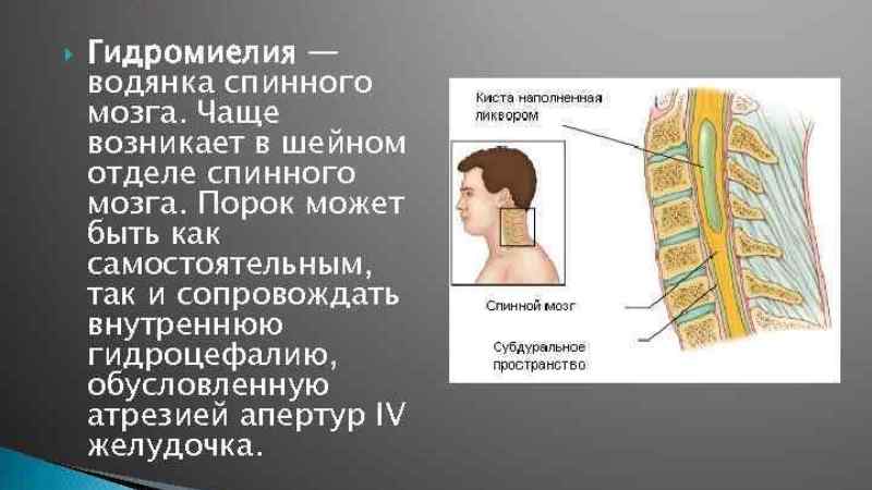 Гидромиелия