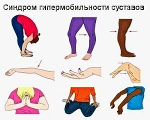 Как лечить синдром гипермобильности суставов