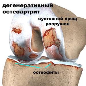 Что такое гонартроз коленного сустава и как его лечить