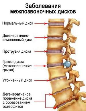 Как применять горчичники для лечения остеохондроза
