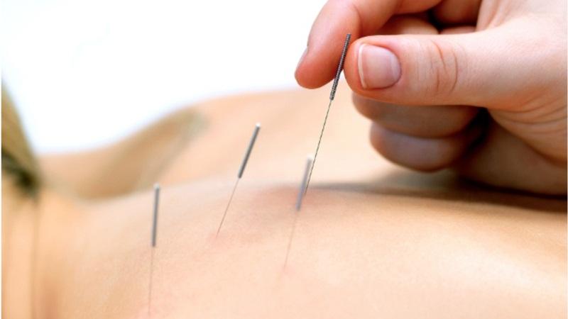 Помогает ли иглоукалывание при остеохондрозе