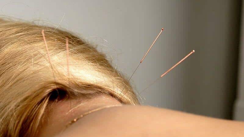 Помогает ли иглоукалывание при остеохондрозе