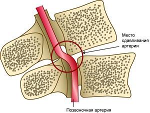 Что такое гипоплазия позвоночной артерии