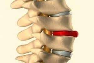 Что такое фораминальная грыжа межпозвоночного диска