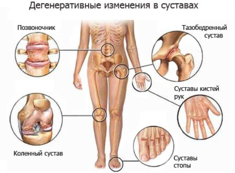 Патологические изменения в суставах