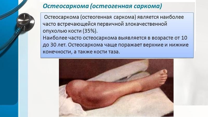 Как лечат остеосаркому
