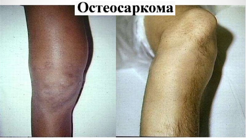 Как лечат остеосаркому