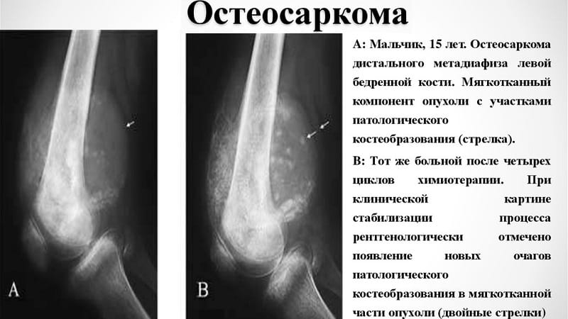 Как лечат остеосаркому