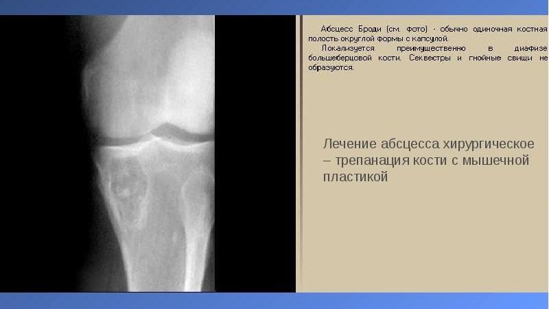 Как лечить абсцесс Броди