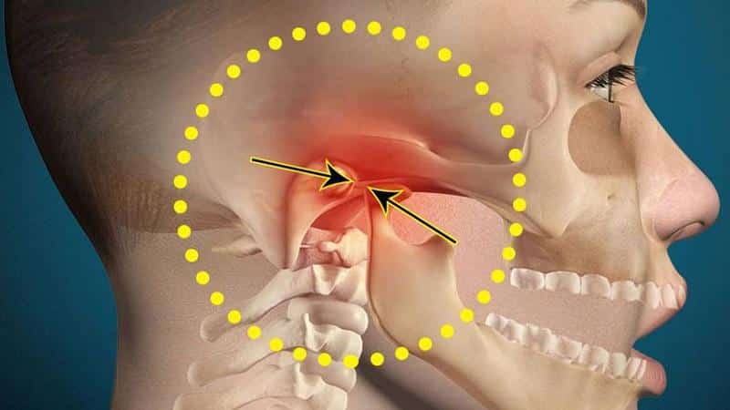 Как лечить дисфункцию ВНЧС