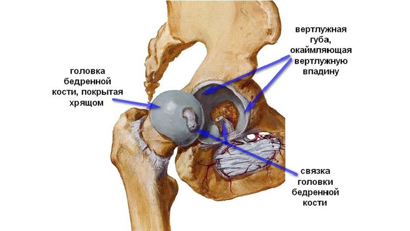 Как лечить диспластический коксартроз тазобедренного сустава