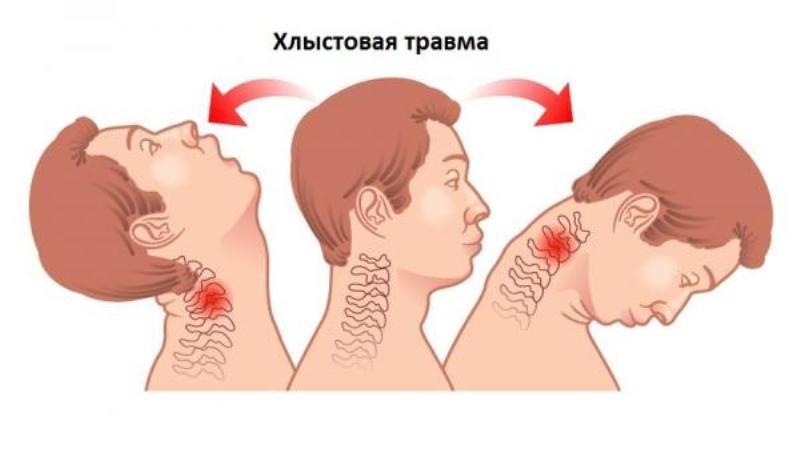 Как лечить хлыстовую травму шеи