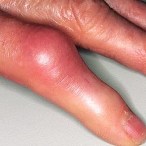 Как лечить кисту на пальце руки