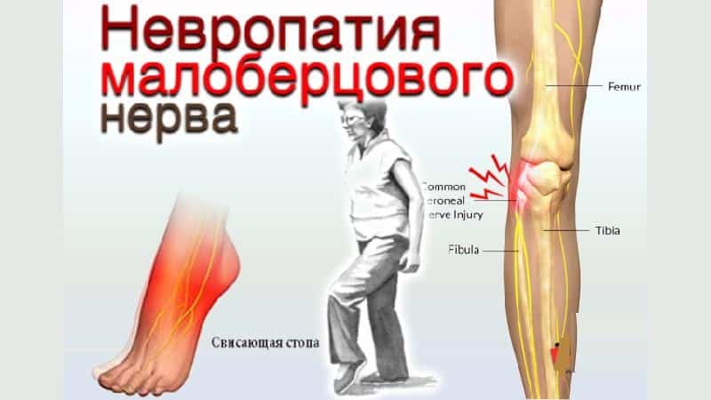 Как лечить нейропатию малоберцового нерва