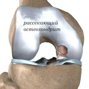 Как лечить остеохондропатию большеберцовой кости