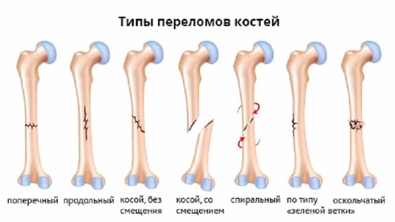 Как лечить перелом ноги