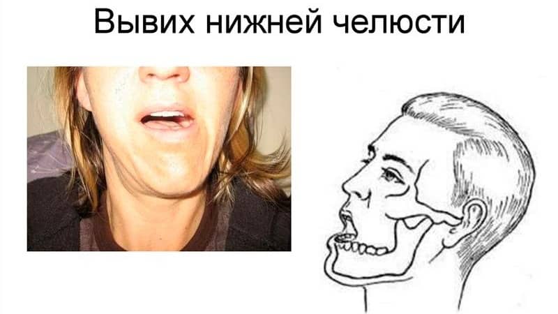 Как лечить подвывих челюстного сустава